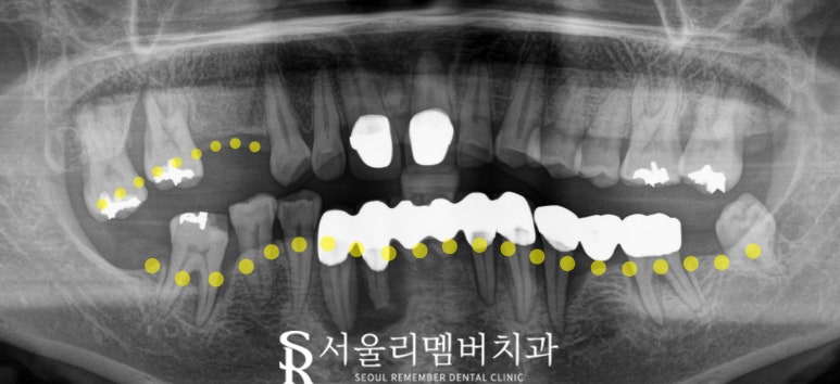 "잇몸에 고름이 차고 흔들려요!" 서울대입구 임플란트 디지털 진료로 치료한 사례 관련 이미지 1