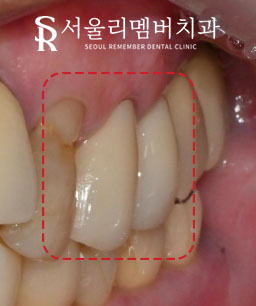 서울대입구역 치과 에서 작은 어금니 깊은 파임, 신경치료 후 통증 없는 크라운 진행 과정 알려드립니다. 관련 이미지 4