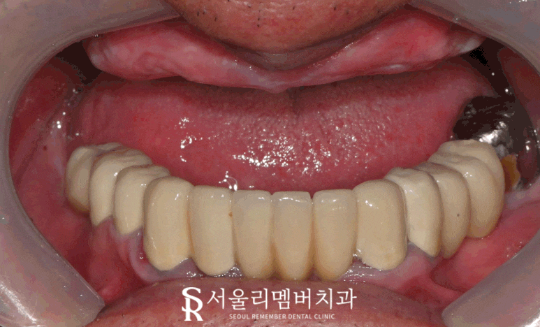 서울대입구역 치과 대표원장이 직접 봐드리는 무치악 환자 전체 임플란트 치료 케이스 관련 이미지 7