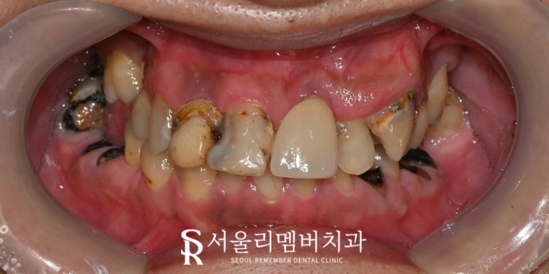 서울대입구역 치과 다발성 우식증 존재할 경우, 신경치료 후 브릿지 수복 과정 관련 이미지 2
