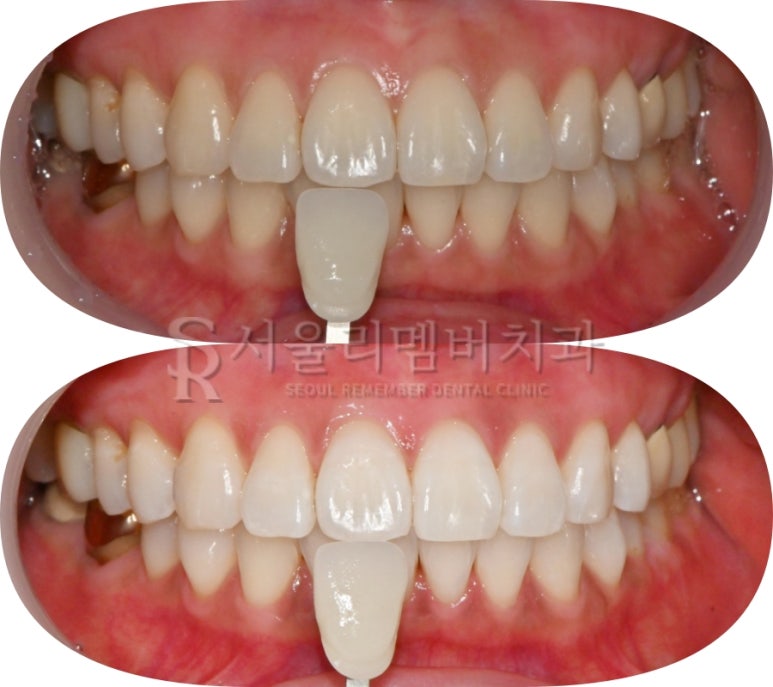 서울대입구역 치과 연말 모임 행사 준비의 시작은 원데이 치아미백 관련 이미지 5