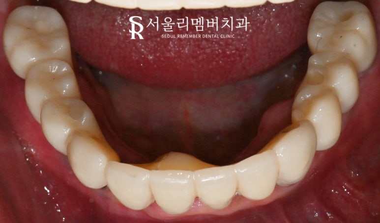서울대입구역 치과 에서 안전하고 신속 정확하게 발치 후 전악 임플란트 식립한 케이스 관련 이미지 7