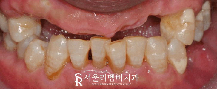 신림역 치과 임플란트 식립 시 어떤 것을 우선적으로 고려하는 것이 좋을까? 관련 이미지 5