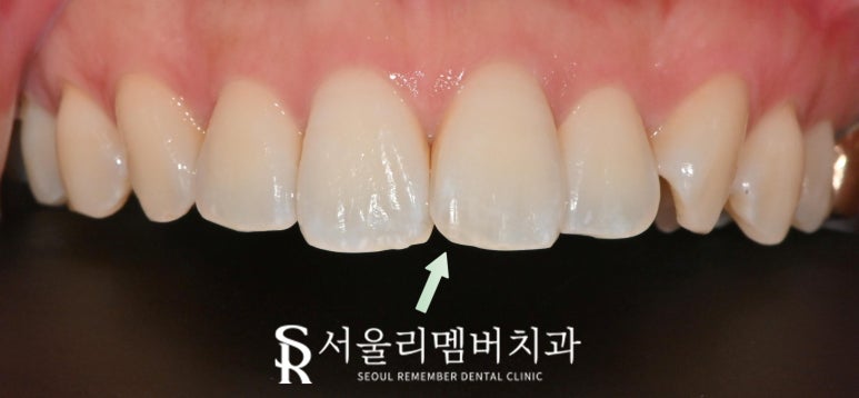 앞니 끝 살짝 깨짐, 보라매 치과 당일 레진으로 비용 부담 없이 1회 내원만에 복원 가능할까? 관련 이미지 2
