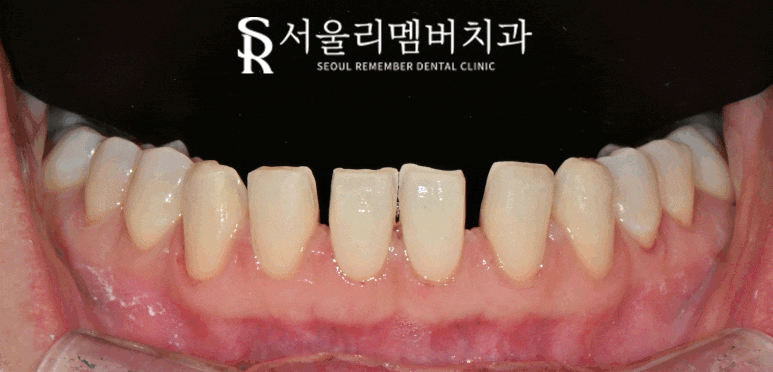 하악 전치 벌어진 공간 스페이스 해소를 위한 아래 앞니 6전치 리얼네이트 라미네이트 케이스 관련 이미지 4