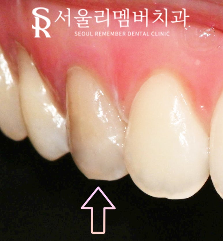 치아의 하얀 반점(화이트 스팟 white spot) 서울대입구역 치과 아이콘 레진으로 무삭제 반점치 충치 치료 관련 이미지 6