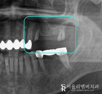 부러진 어금니, 사당역 치과 에서 안전하고 튼튼한 임플란트 식립 방법 관련 이미지 1