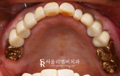 사당역 치과 충치, 치아 흔들림, 파절, 결손, 염증.. 다수의 복합 문제 생겼다면 임플란트 신경치료 크라운 과정 관련 이미지 7