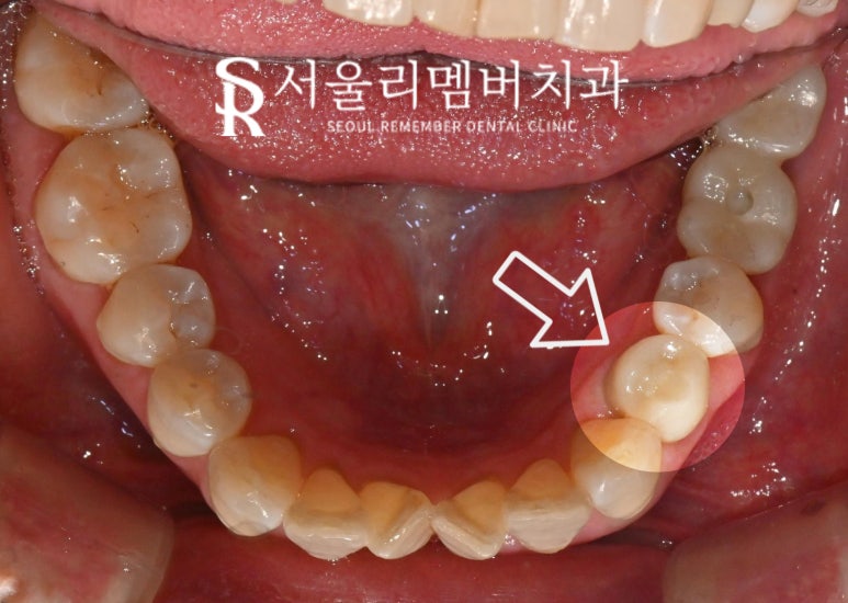 보라매 치과 신경치료 치아 부러짐, 당일 발치 즉시 임플란트 동시 식립(Simple case) 관련 이미지 3