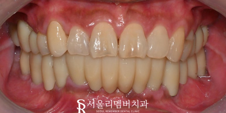 무너진 구강 환경 서울대입구역 치과 에서 편하게 전체 임플란트 치료한 사례 관련 이미지 5