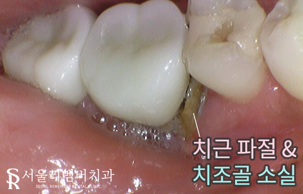 치아 깨지고 통증 있을 때, 서울대입구역 치과 파절 정도에 따른 신경치료 크라운 및 발치 임플란트 관련 이미지 3