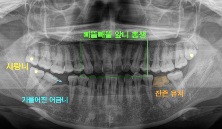 선천적 영구치 결손으로 남아있는 만기 잔존 유치, 서울대입구역 교정 치과 에서 투명 인비절라인 & 임플란트 케이스 관련 이미지 4