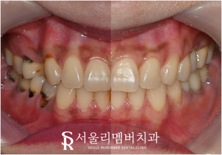 신림 치과 신경치료와 임플란트 어떤 기준으로 결정하게 되는지 궁금하다면 <클릭> 관련 이미지 1
