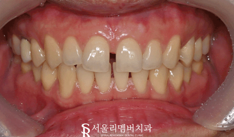 중요한 일 앞두고 앞니가 벌어졌어요. 신대방 치과 에서 레진으로 티 안나게 성형(feat. 다이아스테마) 관련 이미지 3
