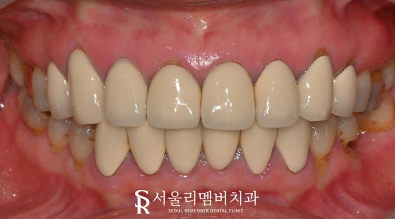 예쁜 미소를 되찾는 순간 낙성대 치과 전악 보철을 통한 치아 심미성 회복의 놀라운 변화 관련 이미지 1