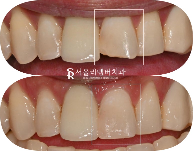 봉천동 치과 앞니 파절 응급 상황에서도 당일 치료 가능한 레진 수복 (해외 거주자도 가능) 관련 이미지 3