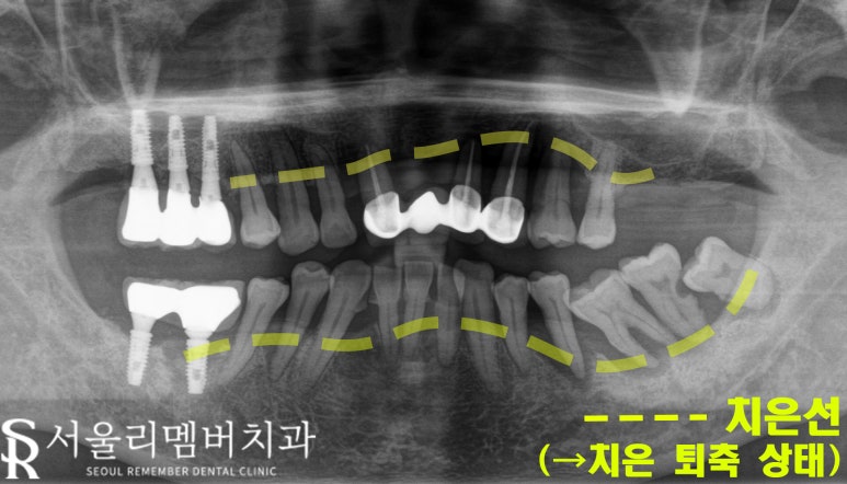 고난도 수술, 서울대입구역 임플란트 치과 에서 치료해야 되는 이유는? 관련 이미지 4