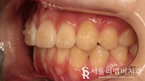 인비절라인을 사용한 치아 총생 개선 증례! 청룡동 치과 관련 이미지 8