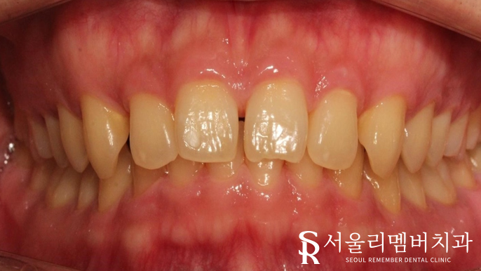 과개교합, 외적인 문제는 물론이며 기능 회복까지 개선하는 것이 중요합니다. 신대방치과 치아교정 관련 이미지 2