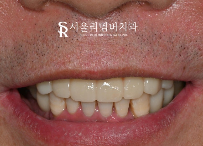 서울대입구역 치과 "부분틀니에서 임플란트로" 바꿔서 전악 개선해 드린 증례 관련 이미지 9