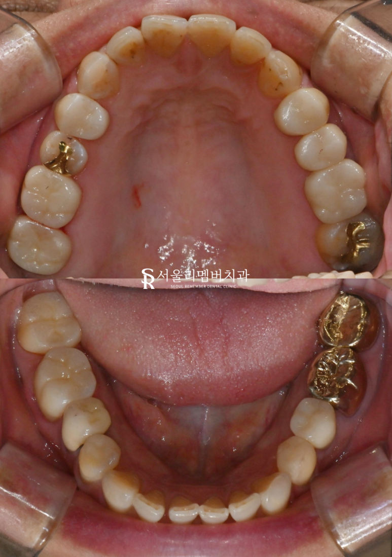 곳곳에 많은 충치, 신림역 치과 에서 앞니 심미 레진 치료와 어금니 지르코니아 크라운 치료 관련 이미지 4