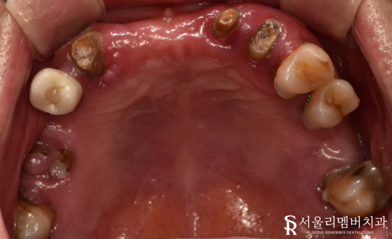빠져버린 치아 그대로 내버려 두면 안모변형을 초래할 수 있습니다! 신림역 서울 리멤버 치과 관련 이미지 2