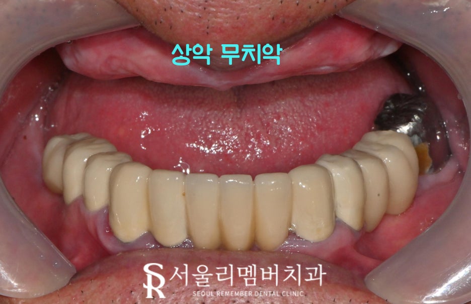 서울대입구역 치과 대표원장이 직접 봐드리는 무치악 환자 전체 임플란트 치료 케이스 관련 이미지 1
