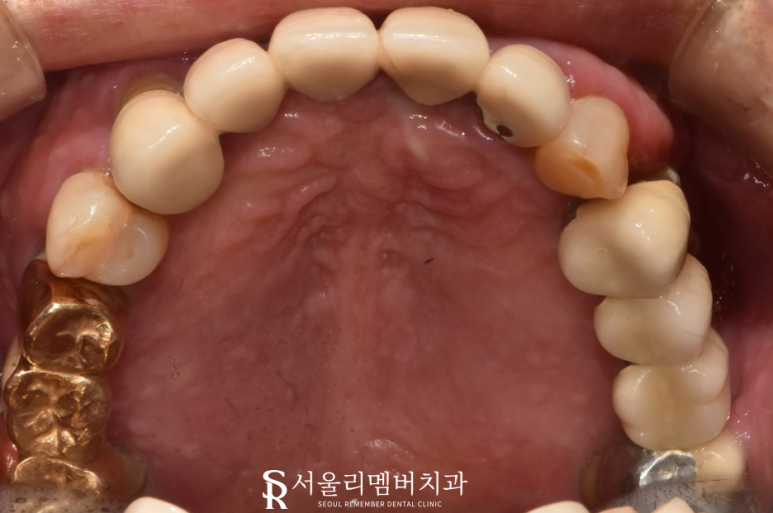 전에 씌워놨던 크라운에서 통증이 느껴져요.. 도대체 왜 그런 거죠? 서울대입구역 서울 리멤버 치과 관련 이미지 2