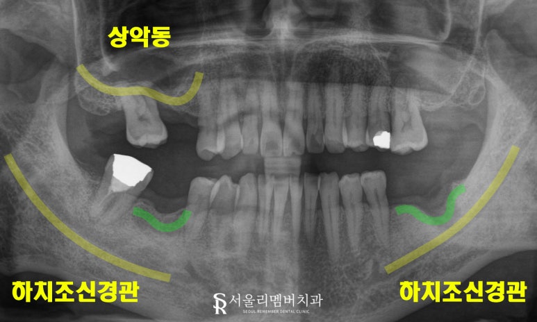 "이제 밥 먹는 것도 문제없어요!" 낙성대 치과 임플란트 로 새로운 구강 환경 찾아 드린 사례 관련 이미지 4