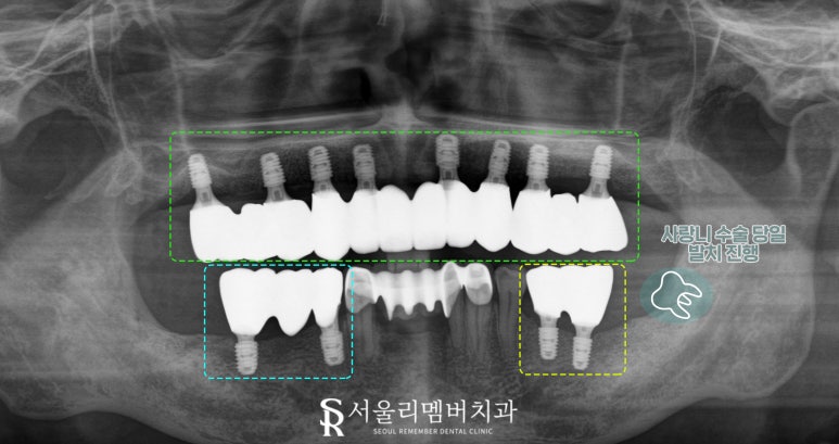 과잉진료 없는 보라매 치과 에서 최소 개수 전악 임플란트 식립 관련 이미지 5