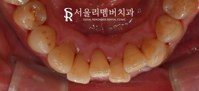 서울대입구역 치과 에서 알려드리는 스케일링의 모든 것-! 관련 이미지 4