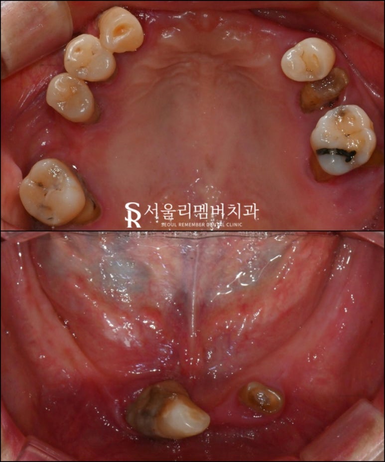 치주염으로 균형이 깨져버린 구강, 신대방 치과 에서 전체 임플란트 수술 증례 관련 이미지 2