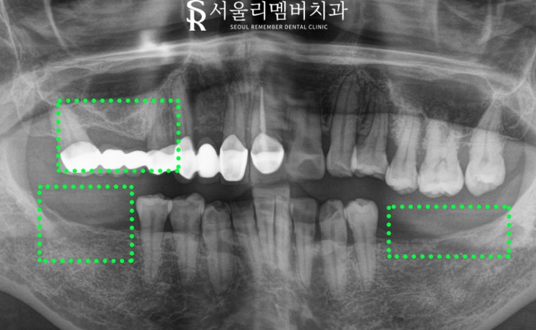 낙성대 치과 "어금니가 없어요." 가이드 임플란트와 신경치료 과정 관련 이미지 5