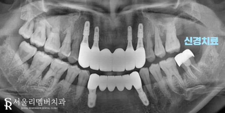 밝게 웃어본 적이 언젠지.. 낙성대역 서울 리멤버 치과 에서 잃어버린 미소를 찾아드렸습니다. 관련 이미지 3