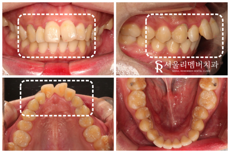 입이 툭 튀어나온 2급 부정교합, 서울대입구치과 발치 교정 증례 관련 이미지 1
