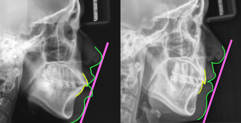 삐뚤어진 앞니 측면 엑스레이 사진 관련 이미지 1