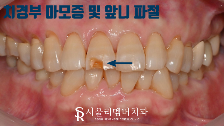 "앞니가 깨졌어요." 서울대입구역 치과 절단연 파절 치료 증례 관련 이미지 1