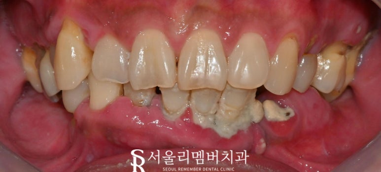 무너진 구강 환경 서울대입구역 치과 에서 편하게 전체 임플란트 치료한 사례 관련 이미지 1