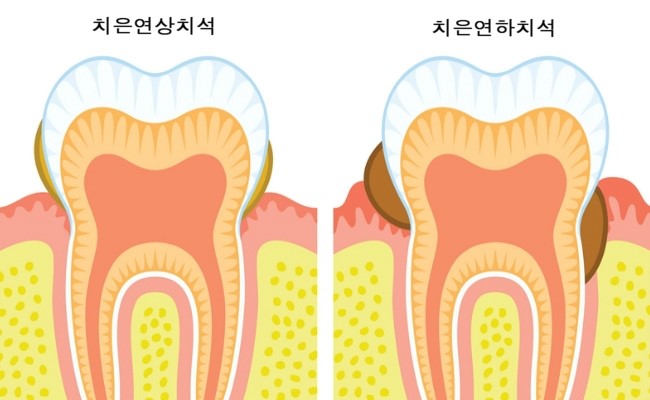 서울대입구역 치과 이렇게만 해도 치아 수명을 늘릴 수 있습니다 관련 이미지 2