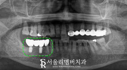 오래된 브릿지에 문제가 생겼어요. 서울대입구역 치과 에서 수면 임플란트 로 해결 관련 이미지 2