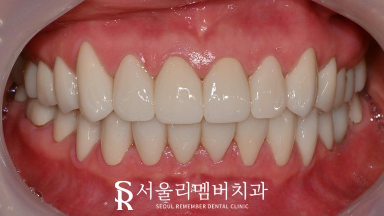 예쁜 미소를 되찾는 순간 낙성대 치과 전악 보철을 통한 치아 심미성 회복의 놀라운 변화 관련 이미지 3