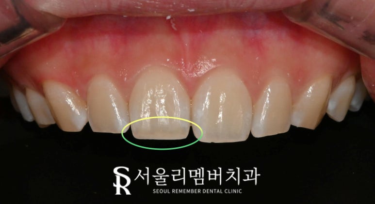 신림역 치과 앞니 끝부분 깨짐 절단연 파절 레진으로 티 안 나게 하루 만에 당일 치료 관련 이미지 2