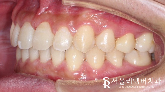 벌어진 치아, 사당 치과 인비절라인으로 개선할 수 있을까? 관련 이미지 10