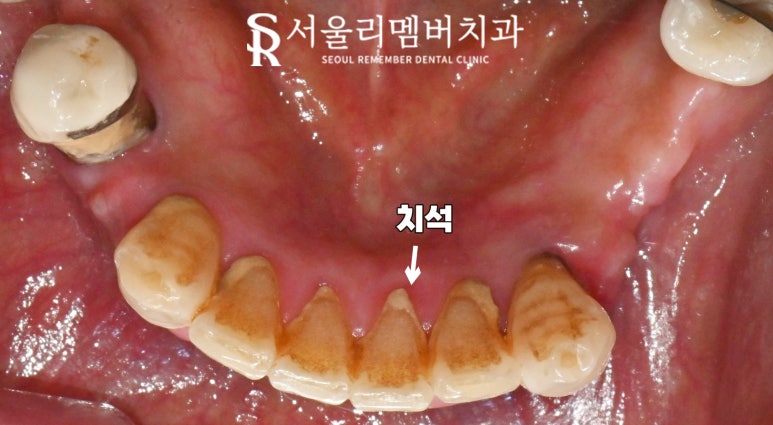 서울대입구역 치과 "부분틀니에서 임플란트로" 바꿔서 전악 개선해 드린 증례 관련 이미지 4