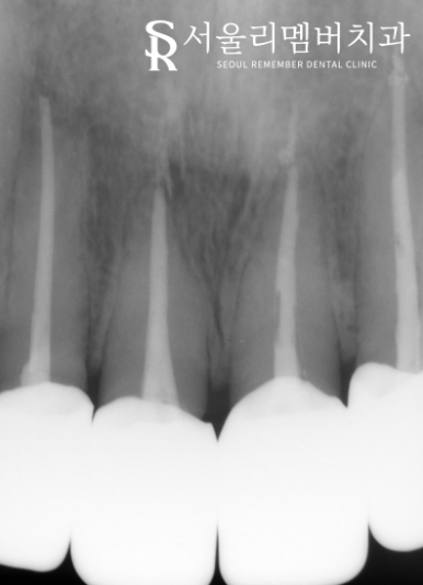 전치부 신경치료, 크라운까지 확실하게 씌워야 되는 이유는? 서울대입구역치과 관련 이미지 3