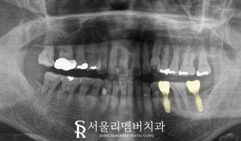 신림 치과 만 65세 이상 보험 임플란트 가격, 비용, 기간, 뼈이식, 크라운 종류 관련 이미지 3