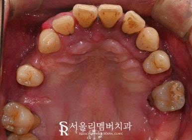 치아 빠지고 흔들리는 어금니와 치주 질환으로 통증 생긴 구강, 관악구 치과 상악 전체 임플란트 및 하악 신경치료 크라운 진행 과정 관련 이미지 3