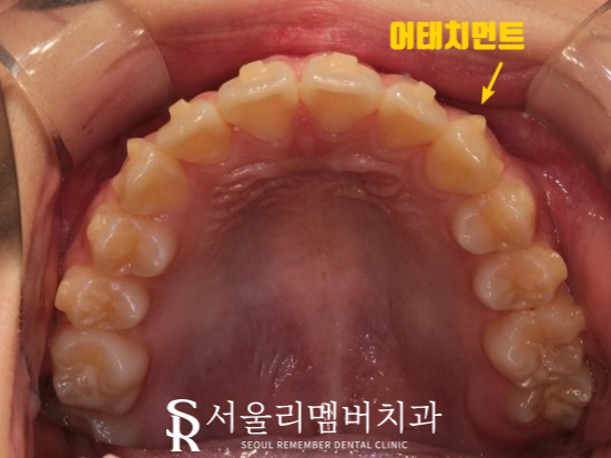 인비절라인을 사용한 치아 총생 개선 증례! 청룡동 치과 관련 이미지 9