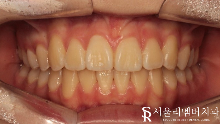인비절라인을 사용한 치아 총생 개선 증례! 청룡동 치과 관련 이미지 12