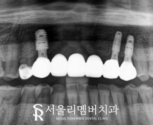 상악 전치부 임플란트 후 고퀄리티 심미보철 로 자신감 되찾으세요! 관련 이미지 3